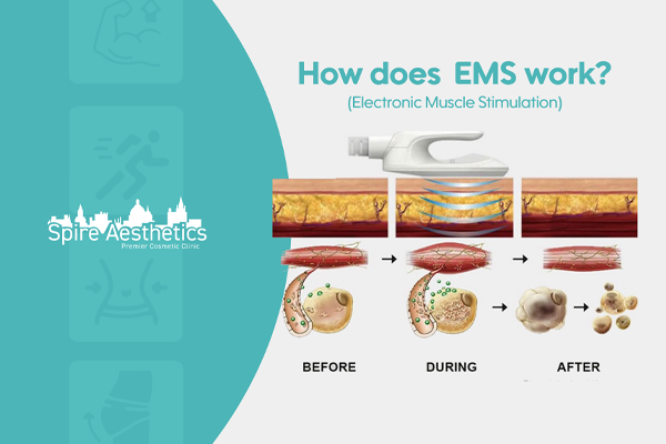 EMS treatment for post pregnancy weight loss treatment Devizes