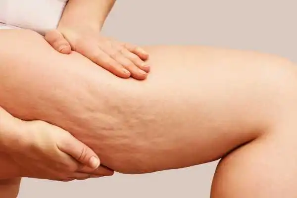 Image of woman showing leg with cellulite Devizes