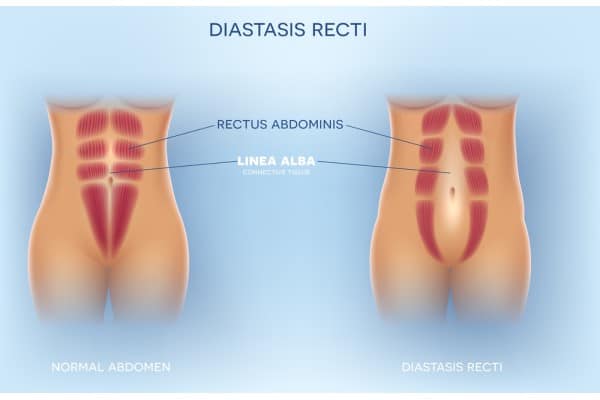What Non-Surgical Options Are Available for Diastasis Recti Devizes?