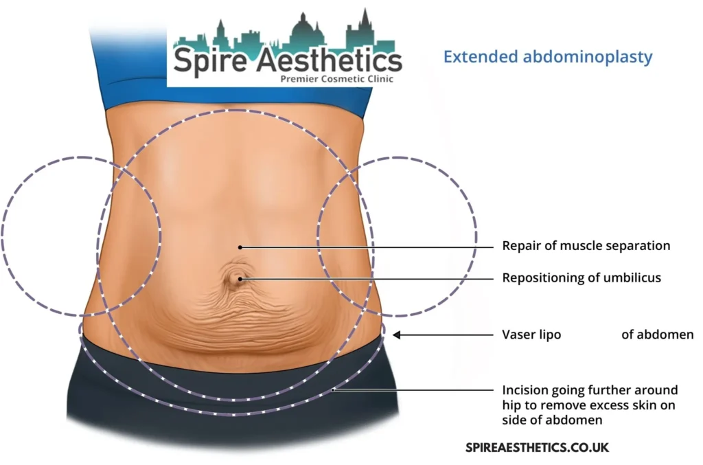 Understanding Loose Skin After Gastric Band Devizes Surgery and HIFU Treatment