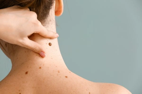 skin blemish removal Devizes treatment
