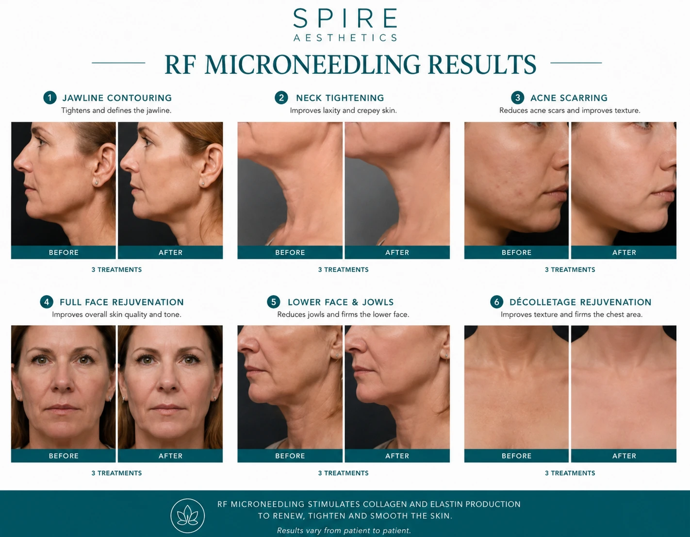 RF Microneedling Skin tightening Devizes results