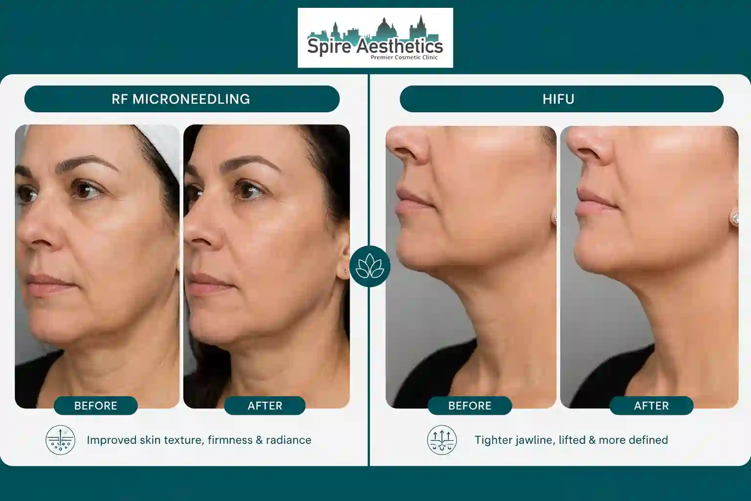 Can RF Microneedling and HIFU Be Combined Devizes?