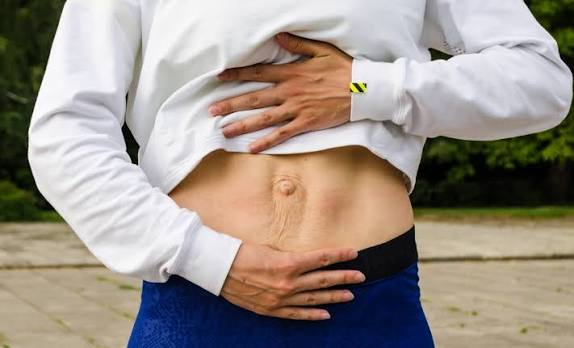 When Could Diastasis Recti Be the Missing Piece of the Puzzle Devizes?