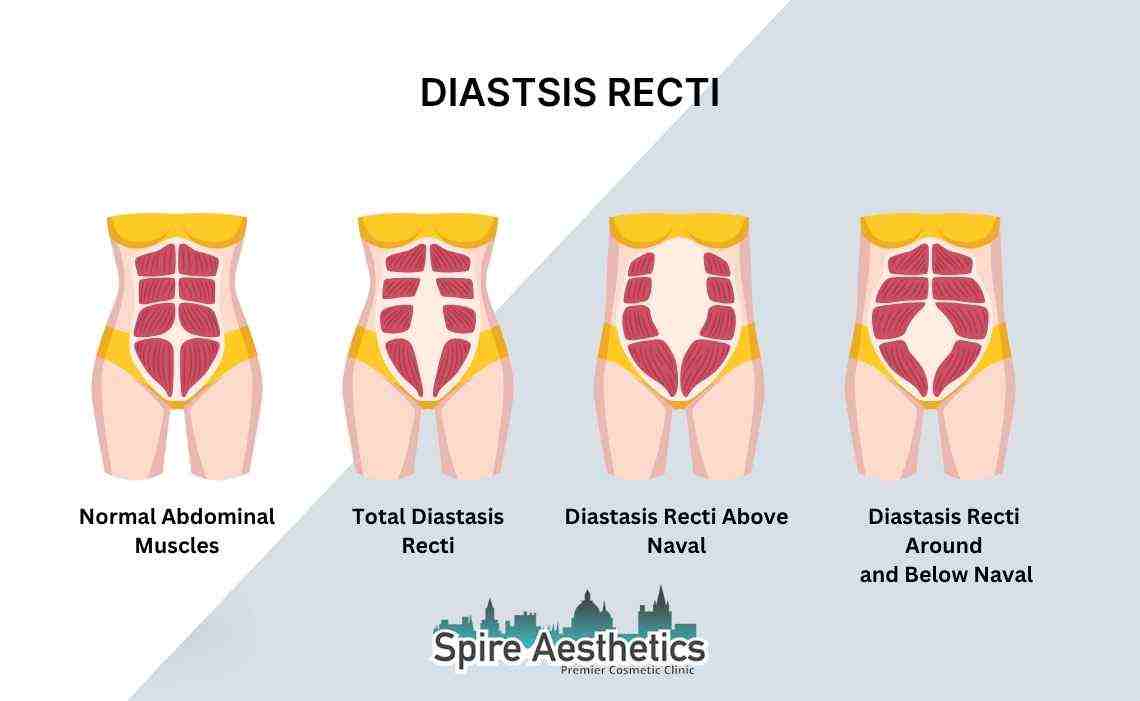 Is Non-Surgical Diastasis Recti Treatment Right for You? Common Concerns Answered Devizes